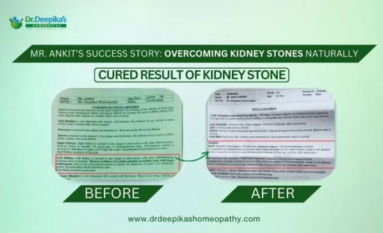 Kidney Stone Condition Treated by Dr. Deepika