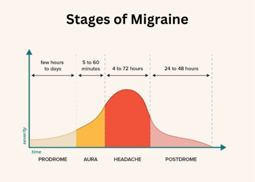 Stages of Migraine