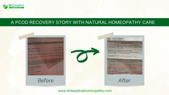 Success Story for PCOS