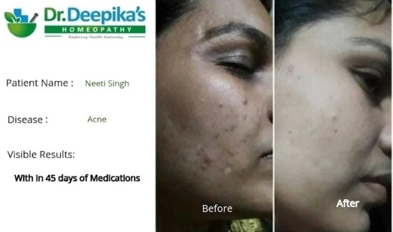 Success Story of Acne