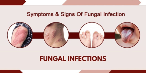 Symptom of Fungal Infection