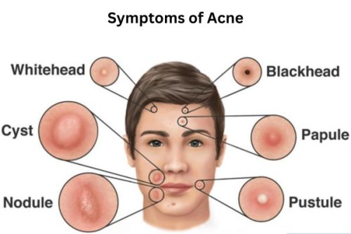 Symptoms of Acne Symptoms of Acne