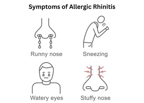 Symptoms of Allergic Rhinitis