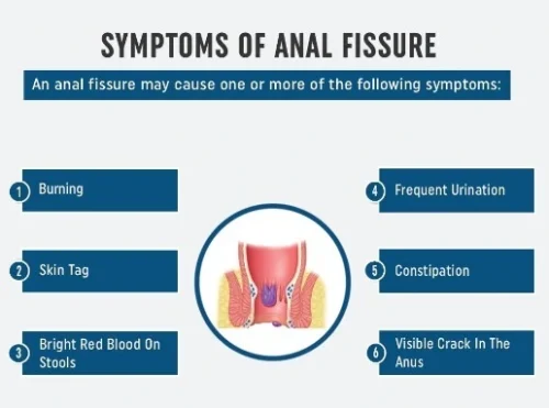 Symptoms of Anal Fissure
