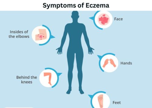 Symptoms of Eczema Symptoms of Eczema