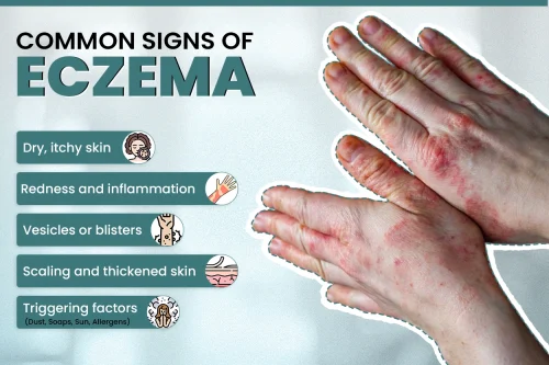Symptoms of Eczema