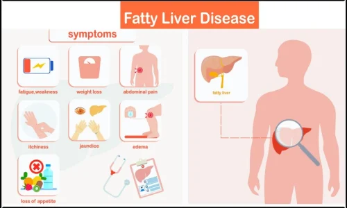 Symptoms of Fatty Liver