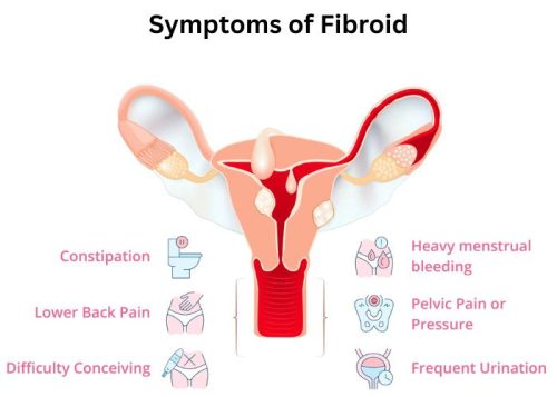 Symptoms of Fibroid Symptoms of Fibroid