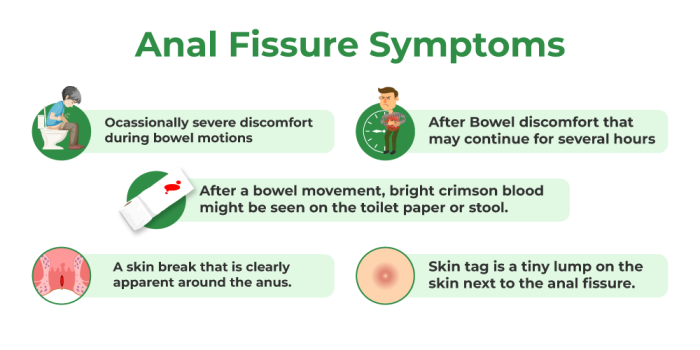 Symptoms of Fissures