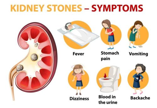 Symptoms of Kidney Stone Symptoms of Kidney Stone