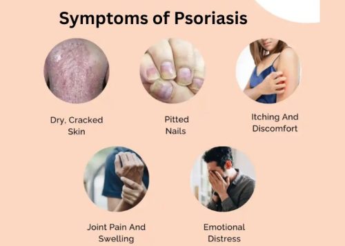 Symptoms of Psoriasis