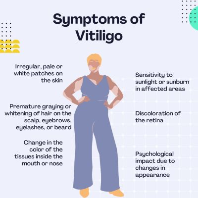 Common Symptoms of Vitiligo Symptoms of Vitiligo