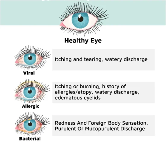 Types of Conjunctivitis