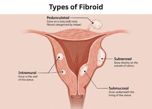 Types of Fibroid Types of Fibroid
