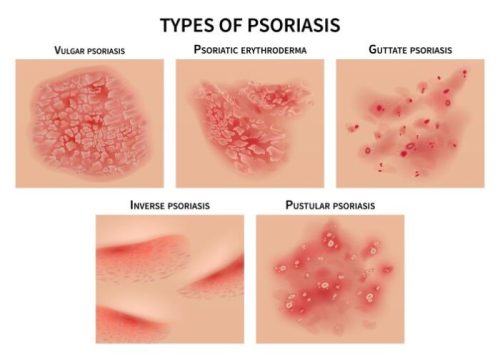 Different Types of Psoriasis Types of Psoriasis