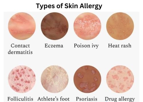 Types of Skin Allergy