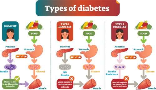 Types of Diabetes