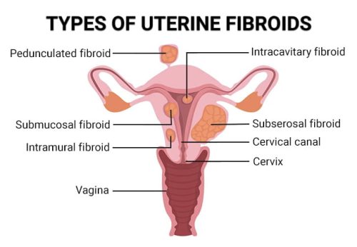 Types of fibroids