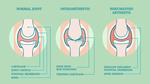 Understanding Joint Pain and Arthritis