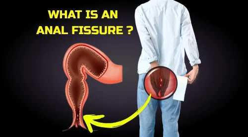 What Is an Anal Fissure?