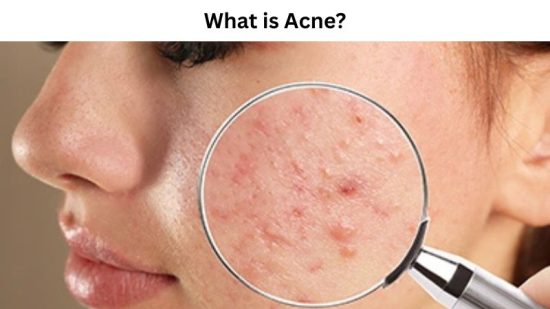 What is Acne