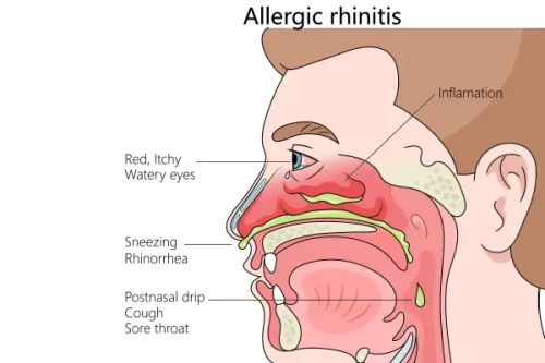 What is Allergic Rhinitis?