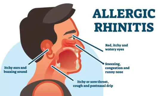 What is Allergic Rhinitis
