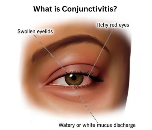 What is Conjunctivitis What is Conjunctivitis?