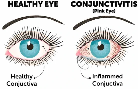 What is Conjunctivitis