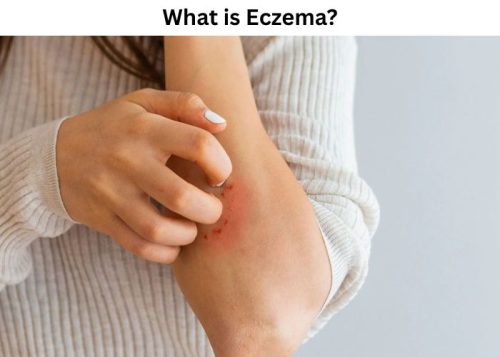 What is Eczema What is Eczema