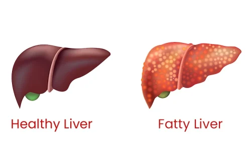 What is Fatty Liver?