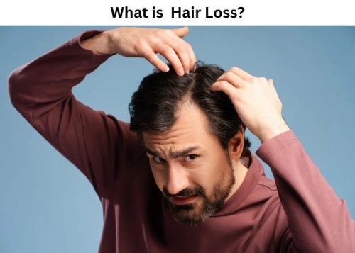 What is Hair Loss What is Hair Loss?