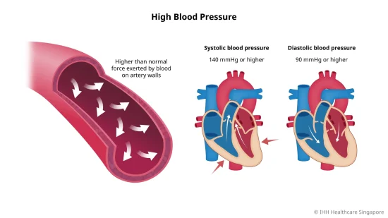 What is High Blood Pressure?