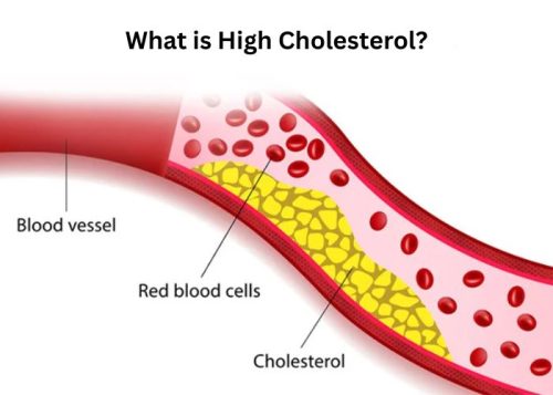 What is High Cholesterol What is High Cholesterol?