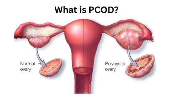 What is PCOD?