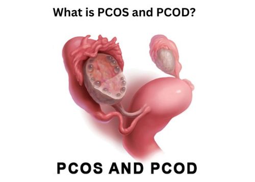 What is PCOS and PCOD