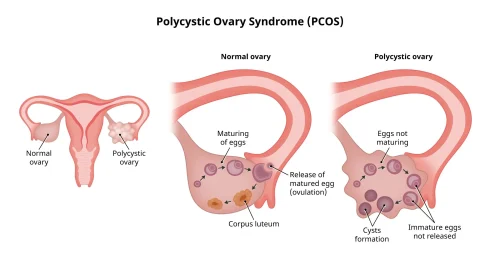 What is PCOS?