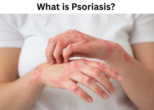What is Psoriasis?