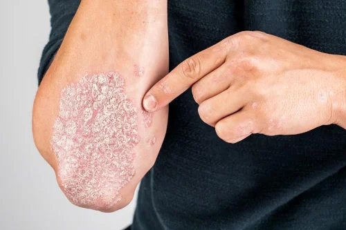 What is Psoriasis?