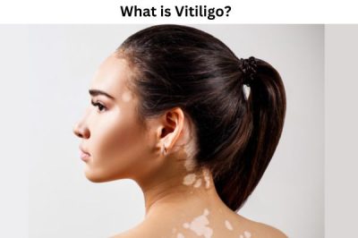 What is Vitiligo What is Vitiligo?