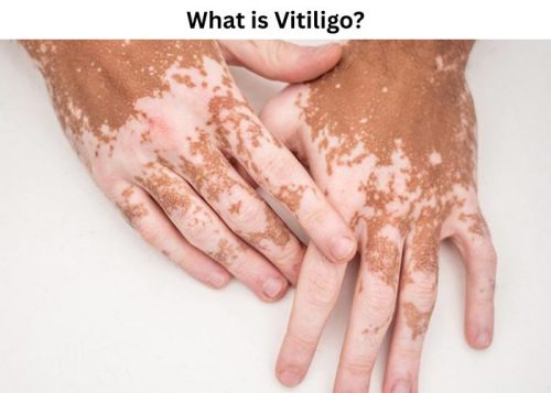 What is Vitiligo What is Vitiligo?