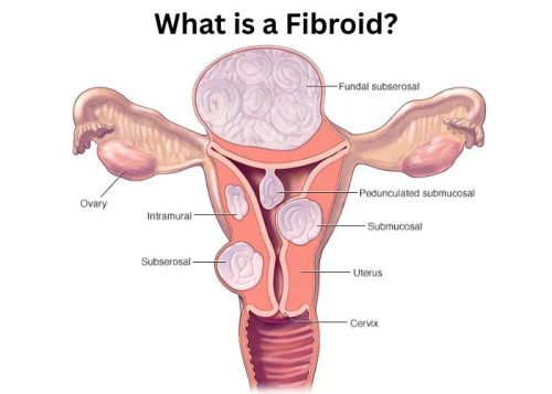 What is a Fibroid What is a Fibroids?