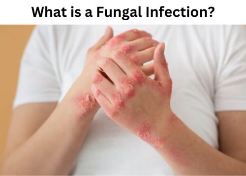 What is a Fungal Infection