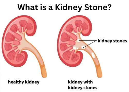 What is a Kidney Stone?