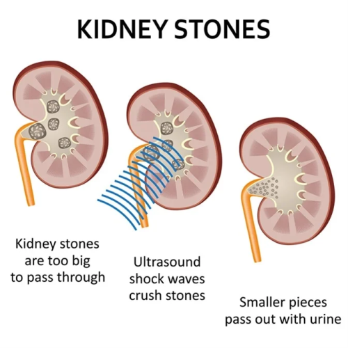What is a Kidney Stone What is a Kidney Stone?