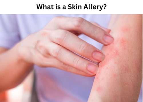 What is a Skin Allergy?