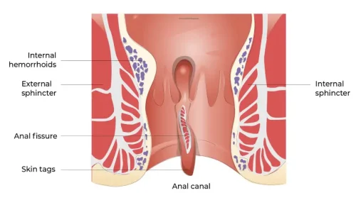 What is an Anal Fissure?