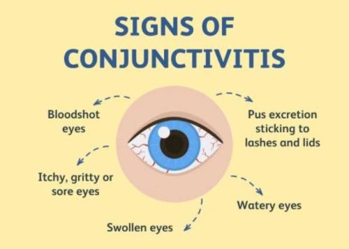 symptoms of Conjunctivitis symptoms of Conjunctivitis