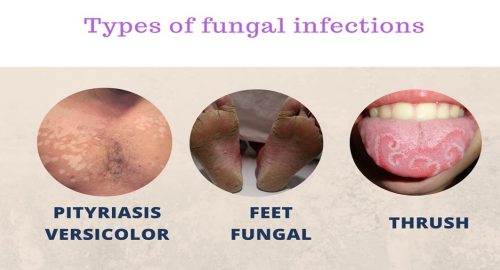 Types of Fungal Infection