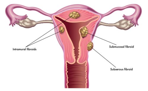what is a fibroid?